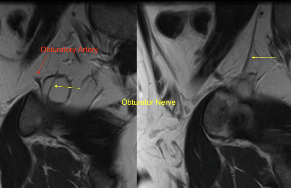 Figure 5 for case Obturator nerve impinge by ganglion cyst